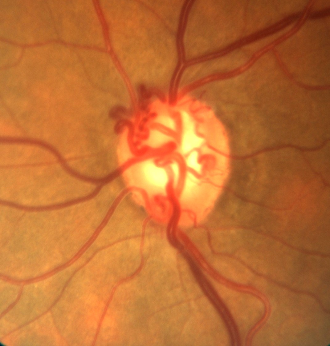 Optic Nerve Evaluation In Glaucoma California Optometric Association